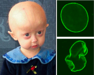 743px-Hutchinson-Gilford_Progeria_Syndrome